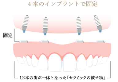 4本のインプラントで固定