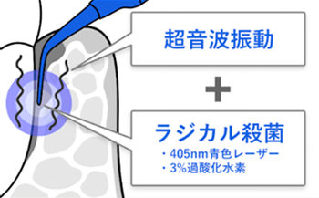 ブルーラジカルにる治療